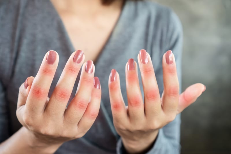 woman hand suffering from joint pain with gout